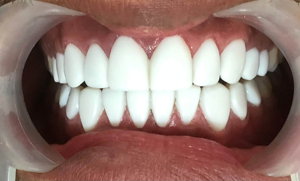 عروض على ابتسامة المشاهير في عيادة لومينا دنت

السابعة مقابل اسواق المولى 📍
للحجز والاستفسار 

+964 773 523 1023 📞
