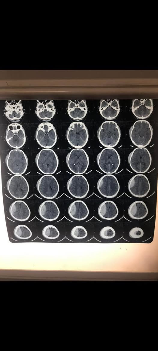 🧠 عملية ناجحة لإزالة نزف ضاغط على الدماغ

تم إجراء عملية جراحية لإزالة نزف كبير فوق الأم الجافية (Epidural Hematoma) كان يسبب ضغطًا على الدماغ، حيث تم بحمد الله إزالة النزف، السيطرة على مصدره، وإعادة عظم الجمجمة إلى مكانه.

📸 الصور المرفقة توضح المفراس قبل وبعد العملية.

👨‍⚕️ الدكتور فاروق العزاوي
   جراح  الجملة العصبية

علاج حالات الصرع • داء الشقيقة • التشوهات الخلقية • أمراض الجهاز العصبي • عمليات الدماغ والعمود الفقري • معالجة إصابات الأعصاب الطرفية وضعف الأعصاب.

🗓 وقت التواجد: السبت عصرًا والأربعاء عصرًا
📍 العنوان: جلولاء – قرب جكليتة ماركت
📞 ***********
