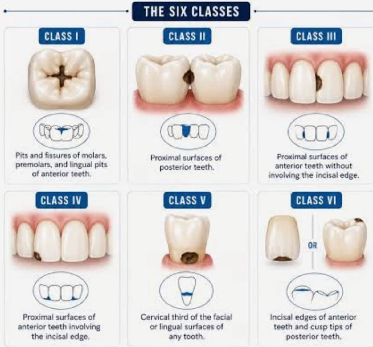 � خدمات علاجية مجانية للفم والأسنان 🦷
تعلن كلية طب الأسنان / جامعة بابل عن توفر خدمات علاجية مجانية بالكامل للفم والأسنان، تُقدَّم تحت إشراف أطباء مختصين.

📞 للحجز والاستفسار: ***********

🔹 الخدمات المتوفرة:

1️⃣ تنظيف الأسنان
2️⃣ أطقم الأسنان الجزئية المتحركة
3️⃣ الحشوات التجميلية   
4️⃣ قلع الأسنان التالفة والجذور المتبقية

📸 نماذج من الحالات والخدمات موضحة في الصور المرفقة.

📍 الموقع:
عيادات كلية طب الأسنان / جامعة بابل
حي الجامعة – الإسكان، مقابل الكراج الموحد

✨ الخدمات مجانية بالكامل وتُجرى تحت إشراف أطباء مختصين

نص مكتوب في الصور:
- عمل حشوات ضوئية تنظيف الأسنان و إزالة التكلسات و التصبغات قلع الأسنان التالفة والجذور المتبقية تعويض الأسنان المفقودة بطقم جزئي متحرك
- THE SIX CLASSES CLASS I Pits and fissures of molars, premolars, and lingual pits of anterior teeth. CLASS II Proximal surfaces of posterior teeth. CLASS III Proximal surfaces of anterior teeth without involving the incisal edge. CLASS IV Proximal surfaces of anterior teeth involving the incisal edge. CLASS V Cervical third of the facial or lingual surfaces of any tooth. CLASS VI OR Incisal edges of anterior teeth and cusp tips of posterior teeth.