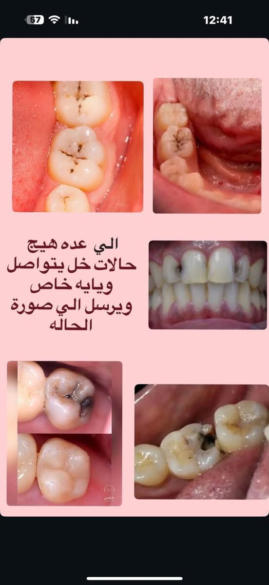 اي شخص يحاتج تنظيف اسنان او حشوة او قلع او تعويض
يتواصل ع واتساب ***********
الموقع _ الدورة مجمع نون والقلم _ جامعة كلكامش.

نص مكتوب في الصور:
- ابتسامتك تستحق العناية قبل بعد احجز الان الدورة مجمع نون والقَم جامعة كلكامش ***********
- الي عده هيج حالات خل يتواصل ويايه خاص ويرسل الي صورة الحاله