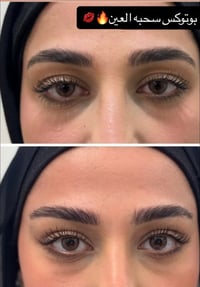 بوتوكس سحبة العين • رفع ذيل الحاجب • عيادة إيفورا