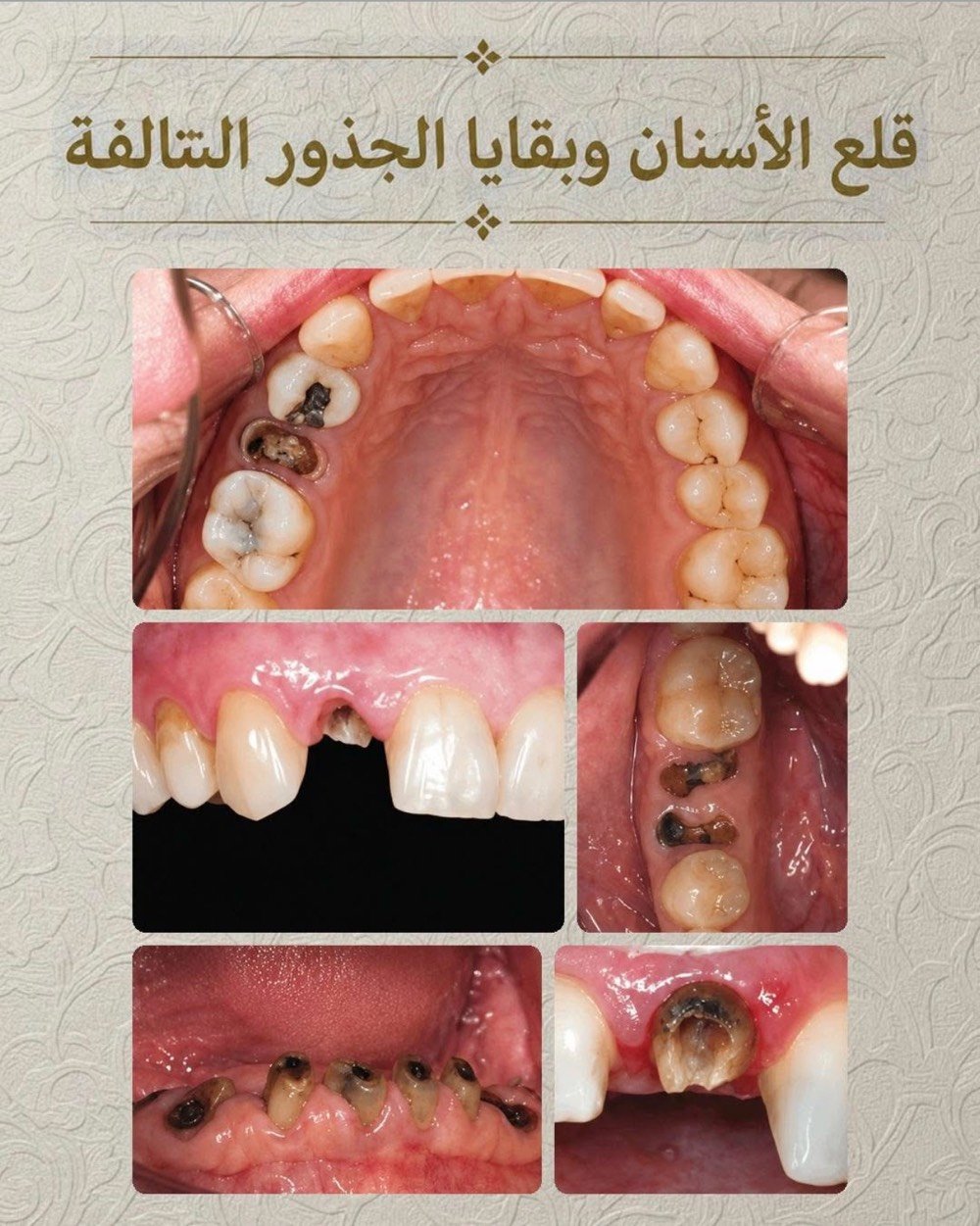 علاج مجاني • عيادات جامعة واسط • تنظيف وحشوات