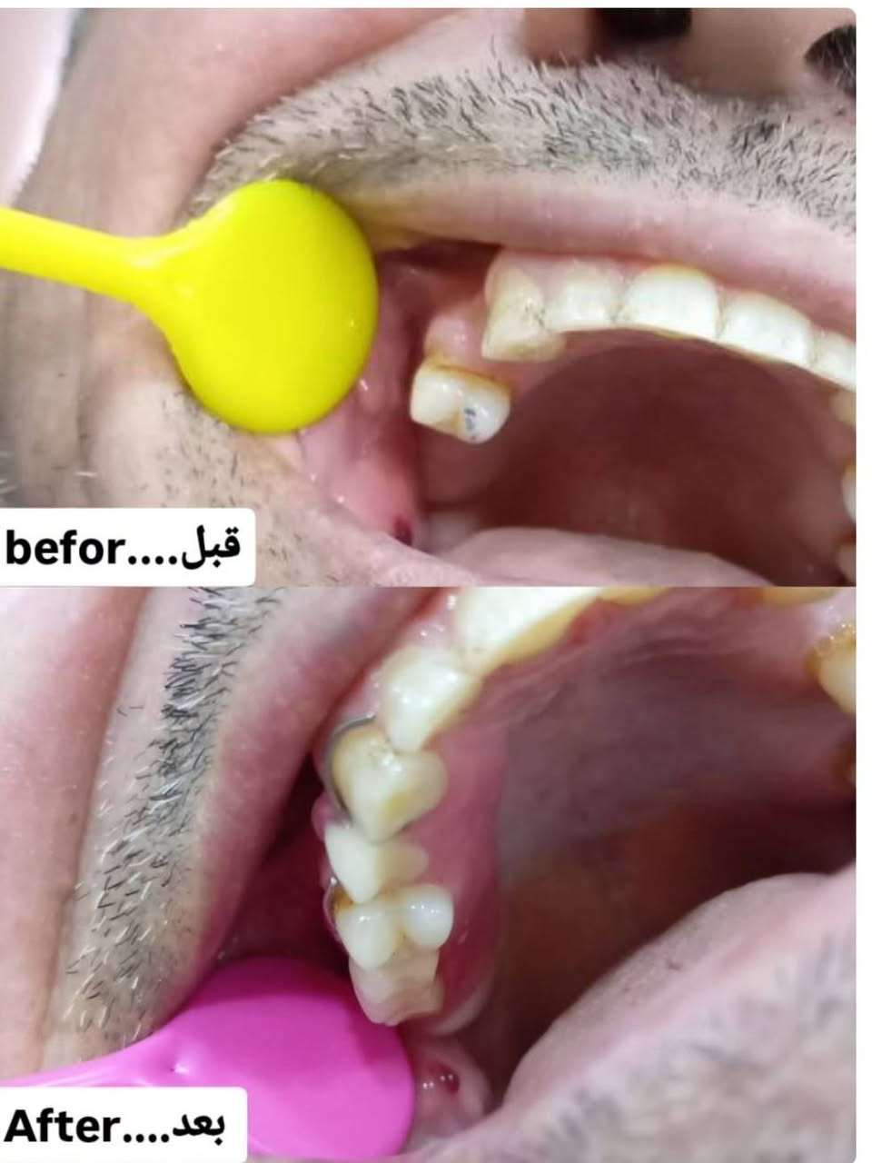 السلام عليكم أهلنا الطيبين...
العلاج مجاني 💯 
إن شاءالله تعالى بداية التاسع نبدي دوام بعيادات طب الأسنان
فأي شخص 1-عنده سن متسوس ويريد حشوة ضوئية.
2-سن منتهي ويريد يقلعه.
3-سن او اكثر ماكو ويريد يعوضهن
4-رجال كبير بالسن وماعنده اسنان ويريد طقم الهن.
5-اطفال اسنانهم متسوسة وتريد عناية.
5-اي شخص عنده فراغات او تزاحم ويحتاج تقويم
6-تشرب جكاير وعندك تصبغات وتكلسات وتريد تنضف أسنانك

هذني كلهم نشتغلهن إن شاءالله تعالى ومجاني بالكامل
فقط عليك سعر الباص الي ميتجاوز الخمس آلاف

عنوانا.... حلة شارع اربعين قرب صيدلية سلامتك أولا
رقم الحجز واتساب مفتوح...***********.
حاليا الحجز مفتوح تواصلوا معنا.
