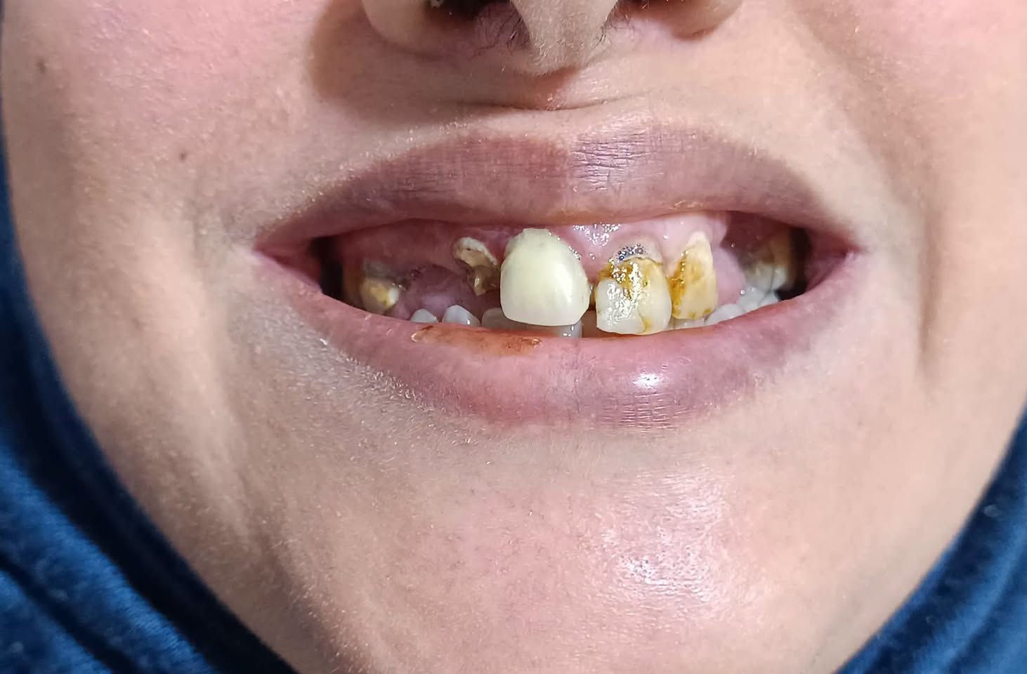 ✨ ابتسامة وثقة 🩵

عيادات الفرح لطب وتجميل الأسنان – فرع حي النصر 🦷

تعويض الأسنان باسنان (الزاركون الألماني) لمراجعتنا من اهالي المشتل 

🦷 ابتسامتك ويّانه غير ☺️
🛡️ ضمان مدى الحياة🔥
#نقد و #اقساط 

📍 العنوان:
حي النصر / شارع السوق / خلف جامع الإمام المهدي
فوق صيدلية مصطفى جاسم أو أسواق الزعيم

📞 ***********

⏰ الدوام: من 4 عصراً إلى 8 مساءً
