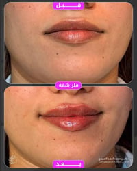 فلر شفايف • نتيجة طبيعية • الموصل