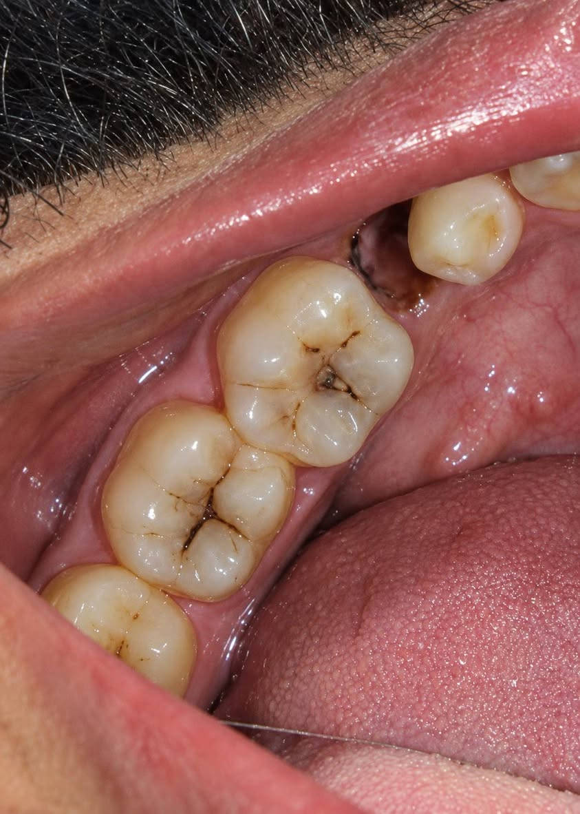 🦷 العلاج مجاني للحالات
بإشراف نخبة من الأطباء المختصين وذوي الخبرة والكفاءة، لضمان تقديم رعاية وعلاج بمستوى مهني مميز. 🤍
📍 عيادات بيارق العميد – السعدية، خلف مول الحارث
📩 للتواصل: خاص أو واتساب
📱 ***********

نص مكتوب في الصور:
- الدكتوره زهراء كريم العلاج مجاني للحالات بإشراف نخبة من الأطباء المختصين وذوي الخبرة والكفاءة، لضمان تقديم رعاية وعلاج بمستوى مهني مميز. ابتسامتك .. تستحق الأفضل قلع الاسنان والجذور المتبقيه الحشوات الضوئيه التجميليه تنظيف الأسنان من التكلسا ت وتلميعها تعويض الأسنان المفقوده بالتراكيب السنيه المتحركه عيادات بيارق العميد السعدية - خلف مول الحارث *********** للتواصل: خاص أو واتساب
- DR. AMJAD ALQAYYUM DENTAL CLINIC