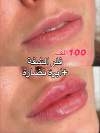 دكتورة زينة • فلر الشفة • ابرة نضارة