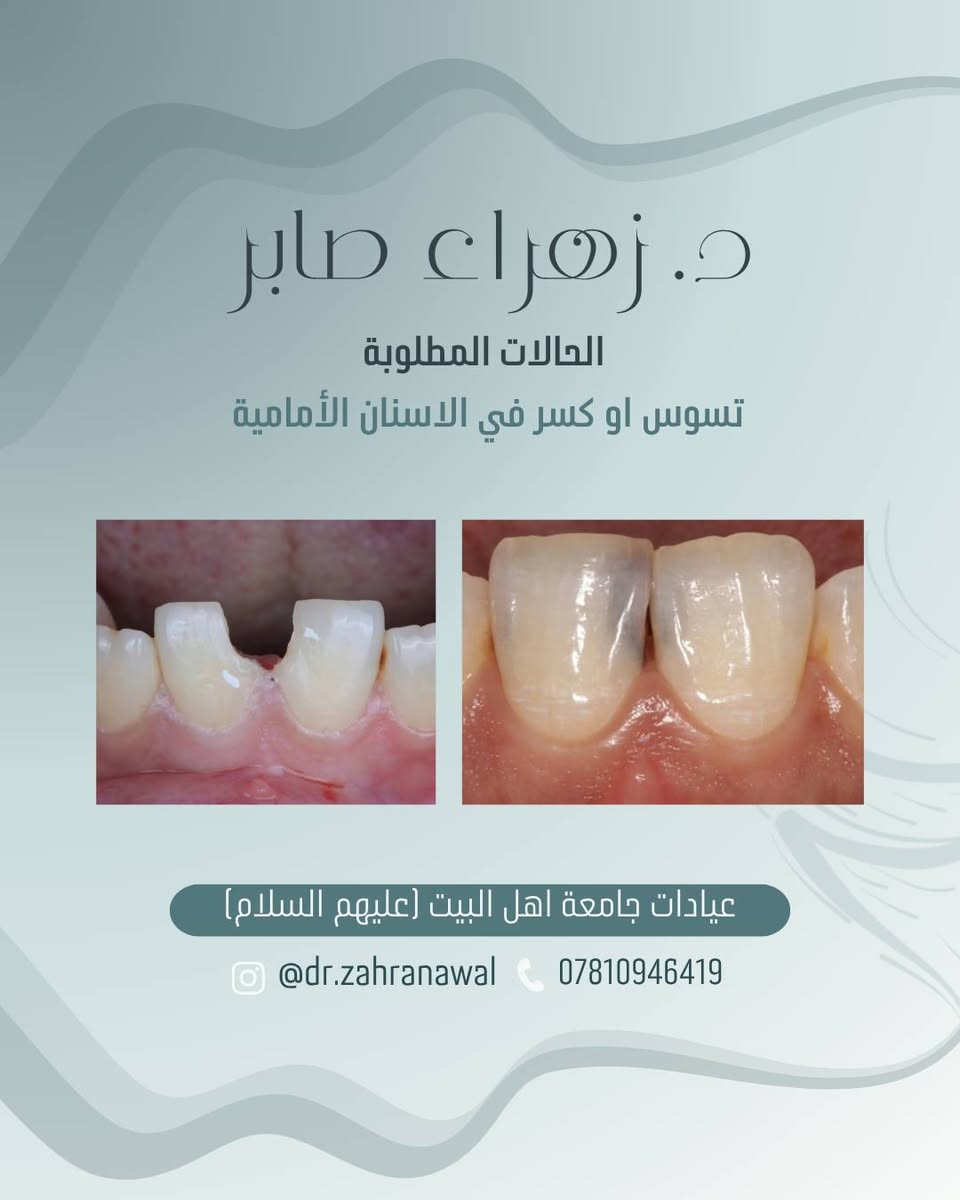 العلاج مجاناً 🤍
إذا كانت حالتكم مطابقة للحالات المطلوبة أو لديكم استفسار، يمكنكم التواصل معي عبر الخاص أو الانستغرام أو رقم الهاتف الموجود في الكارت.

أهلاً وسهلاً بكم، ونسعد بخدمتكم.

نص مكتوب في الصور:
- د. زهراء صابر
- فحص الفم والاسنان
- قلع الاسنان والجذور المتبقية
- تنظيف الاسنان وازالة التكلست
- عمل الحشوات الضوئية (تجميلية)
- تعويض الاسنان المفقودة بطقم جزئي
- عيادات جامعة اهل البيت (عليهم السلام)
- @dr.zahranawal
- ***********
- علماً العلاج مجاناً
- الحالات المطلوبة
- تمبغات او تكلسات حول الاسنان
- @dr.zahranawal ***********
- د. زهراء صابر الحالات المطلوبة تسوس في الاسنان الخلفية عيادات جامعة اهل البيت (عليهم السلام) @dr.zahranawal ***********
- تسوس او كسر في الاسنان الأمامية
- د. زهراء صابر الحالات المطلوبة بقايا الجذور والاسنان التالفة والقلع لغرض التقويم عيادات جامعة اهل البيت (عليهم السلام) @dr.zahranawal ***********