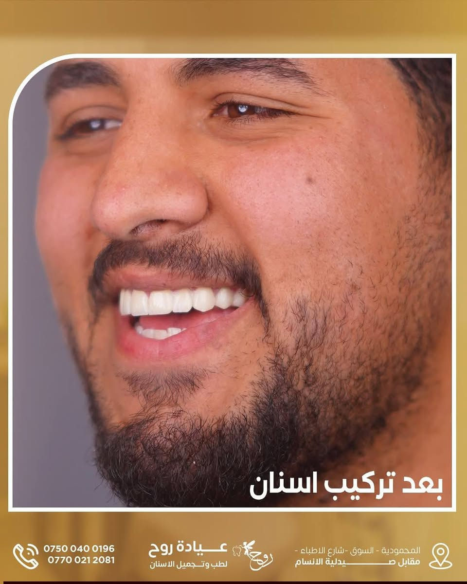 عياده روح لطب وتجميل الاسنان 
د.زهراء صادق 
"لأن ابتسامتك عنوان جمالك، نوفر لك في عيادة روح لطب الأسنان أحدث التقنيات للحصول على ابتسامة مثالية ✨. 

زورونا في المحمودية - شارع مقابل صيدلية الأنسام للحصول على العناية التي تستحقها. 
📞 للحجز والاستفسار: 
*********** 
*********** 

#ابتسامتكم_يحتاجلها_روح⭐️
