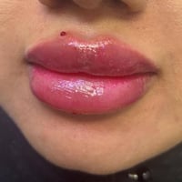 تجميل • شفاه • ليزر حديث