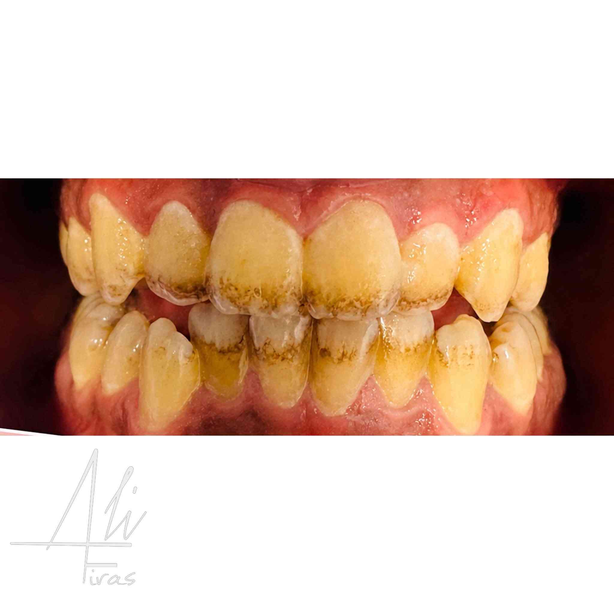 � ابتسامتك تستحق العناية… وخدمتك عندنا مجانًا! 🦷
📢 إلى أهلنا الكرام:
 نقدم خدمات علاجية مجانية بالكامل وتحت إشراف أطباء اختصاص.

✨ تشمل الخدمات:
• حشوات ضوئية تجميلية للأسنان الأمامية والخلفية
• تنظيف الأسنان من التكلسات وإزالة الجير
• قلع الأسنان التالفة
• إزالة الجذور المتبقية
• تركيب طقم أسنان كامل

💙 العلاج مجاني بالكامل
👨‍⚕️ العمل يتم تحت إشراف أطباء اختصاص
🦷 فرصة للعناية بصحة أسنانك واستعادة ابتسامتك
للتواصل على الخاص او على الرقم ***********

نص مكتوب في الصور:
- Ali Firas
