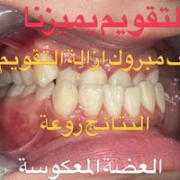 تقويم الأسنان • تقدم الفك السفلي • بغداد الكرخ