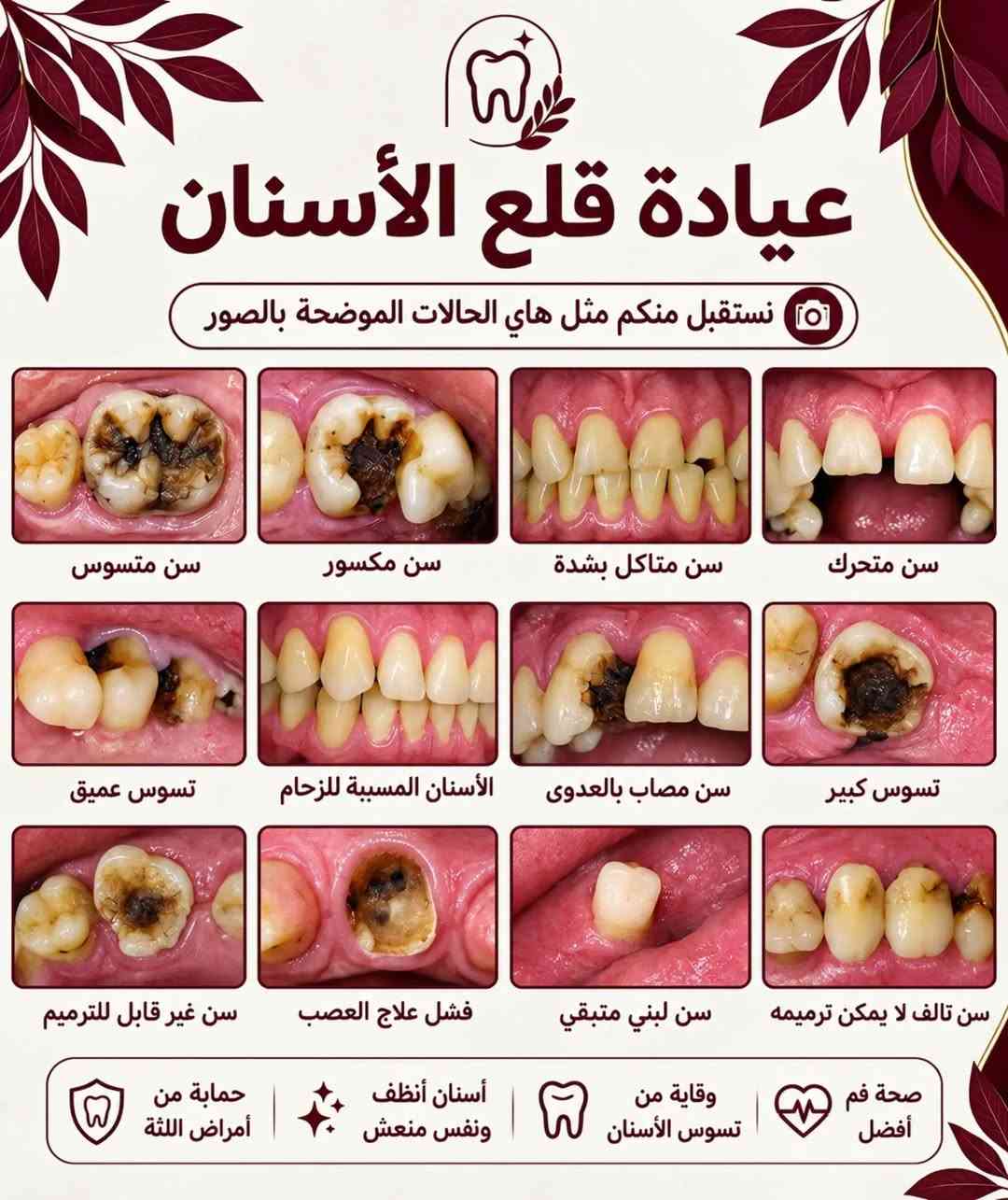 قال تعالى 
﴿وَمَا تَوْفِيقِي إِلَّا بِاللَّهِ ۚ عَلَيْهِ تَوَكَّلْتُ وَإِلَيْهِ أُنِيبُ﴾

بعد سنوات من الدراسة والتعلم النظري والعملي، أبدأ مرحلة جديدة ومهمة في مسيرتي كطالب طب أسنان: العيادات السريرية.
خلال هذه المرحلة سأشارككم جانبًا من الحالات والخدمات التي نستقبلها في العيادات السريرية، بالإضافة إلى معلومات ونصائح بسيطة تساعدكم على الاهتمام بصحة الفم والأسنان.
📍 جامعة العين العراقية – المستشفى التعليمي لكلية طب الأسنان
إذا كنت بحاجة إلى إحدى الخدمات التي نعلن عنها، يمكنك التواصل معي عبر الرسائل لمعرفة التفاصيل ومواعيد الاستقبال.

#الناصرية #طب_اسنان #العراق #اكسبلور

نص مكتوب في الصور:
- د. الحسن علي العبودي طالب طب أسنان تنظيف الأسنان من التصبغات و إزالة التكلسات معالجة الأسنان بالحشوات الضوئية (التجميلية) قلع الأسنان والجذور التالفة تعويض الأسنان المفقوده بطقم جزئي متحرك الموقع شارع النيل _ حي الشهداء _ جامعة العين العراقية _ المستشفى التعليمي لكلية طب الأسنان ملاحظة وذلك بأشراف نخبة من الأطباء المختصين مع إستخدام أحدث الأجهزة و المواد لضمان أفضل النتائج و العلاج مجاني بالكامل alhassanalii19 *********** ***********
- عيادة تنظيف وإزالة تكلسات الاسنان نستقبل منكم مثل هاي الحالات الموضحه بالصور حماية من أمراض اللثة أسنان أنظف ونفس منعش وقاية من تسوس الأسنان صحة فم أفضل الي عنده مثل هاي الحالات او يعرف شخص آخر محتاج تنظيف فخلي يتواصل معنا
- عيادة قلع الأسنان نستقبل منكم مثل هاي الحالات الموضحة بالصور سن متسوس سن مكسور سن متآكل بشدة سن متحرك تسوس عميق الأسنان المسببة للزحام سن مصاب بالعدوى تسوس كبير سن غير قابل للترميم فشل علاج العصب سن لبني متبقي سن تالف لا يمكن ترميمه حماية من أمراض اللثة أسنان أنظف ونفس منعش وقاية من تسوس الأسنان صحة فم أفضل
- عيادة الحشوات التجميلية (الضوئية)
- نستقبل منكم مثل هذه الحالات الموضحة بالصور
- 1
- فئة (1)
- 2
- فئة (2)
- 3
- فئة (3)
- 4
- فئة (4)
- 5
- فئة (5)
- عيادة التعويضات السنية المتحركة
- (في الفكين العلوي و السفلي)
- صحة فم أفضل
- وقاية من تسوس الأسنان
- أسنان أنظف ونفس منعش
- حماية من أمراض اللثة