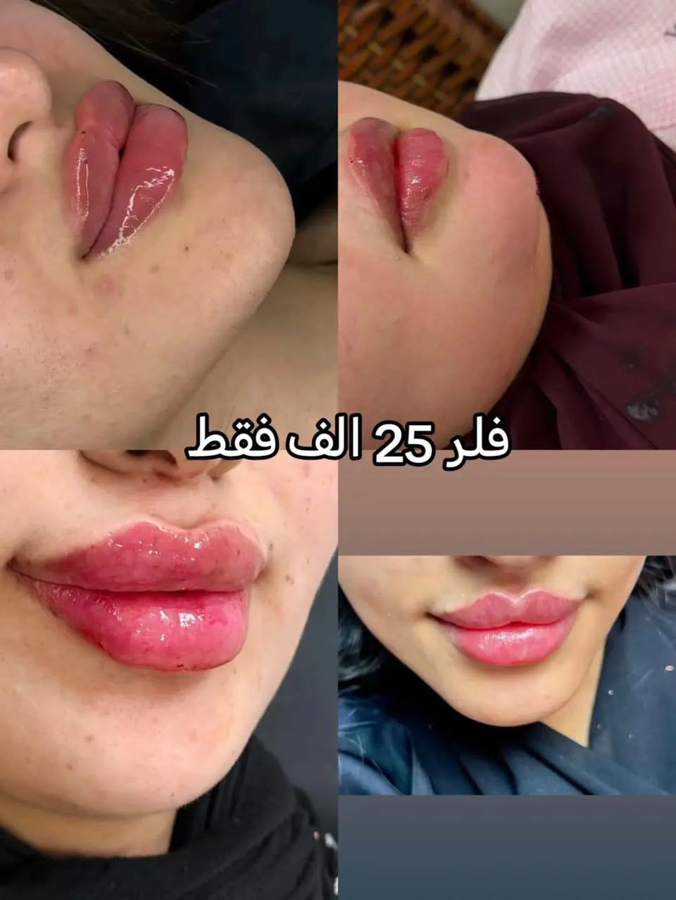 السيسي الواحد 25 الف
عيادة ايفا للتجميل والأسنان 💉🦷
دكتور محمد سعدون ودكتوره شيماء احمد 

العنوان #مدينة الصدر الكياره قطاع٦٧ مقابل نادي الجولان

‏‪***********‬‏📞
#اكبلور_العراق_السعوديه_الاردن_ايران_الكويت_طق_لايك_ات_كومنت_يلاا💜_فولو_بغداد_ميوزكلي_ #مدينة #فلر_شفايف #مدينةالصدر
