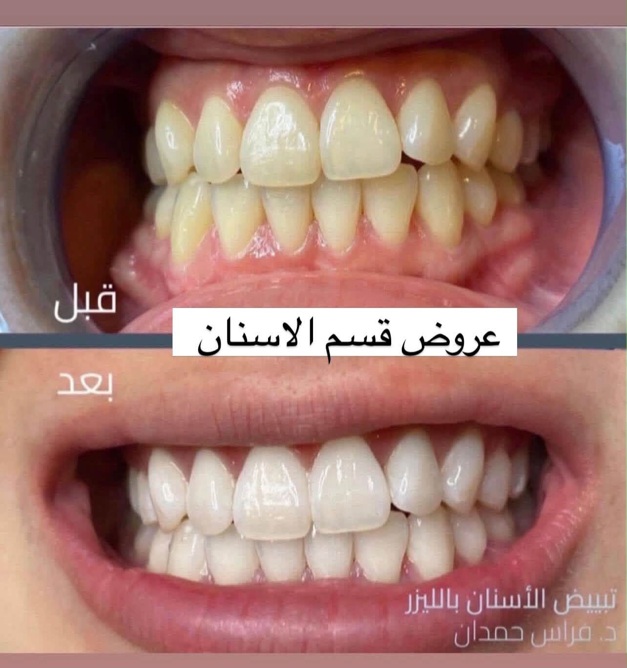 د. فراس حمدان • تقويم أسنان • تبييض بالليزر