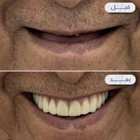زراعة أسنان • ابتسامة طبيعية • زعفرانيه