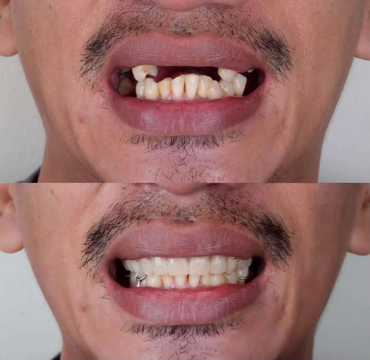 سلام عليكم من يعرف احد عنده مثل هاي حالات  علاج مجاناً في سبيل الله الي يريد يتفضل خاص او واتساب ***********

نص مكتوب في الصور:
- clinical Tips & tricks Indicated 5th Stage Case
- Complete Dentures © Alexander Shor
- affinitydental
