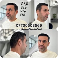 زراعة شعر • VIP • بالتخدير