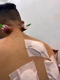حجامة الأخدعين • ضغط الدم • ألم الرقبة والكتفين