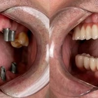 يتوفر لدينا زراعة اسنان و بسعر مناسب جدا  و يقوم بالزراعة طبيب اخصائي ...