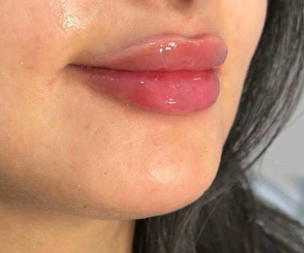25 ألف فقط
عيادة ايفا للتجميل والأسنان 💉🦷

العنوان #مدينة الصدر الكياره قطاع٦٧ مقابل نادي الجولان

‏‪***********‬‏📞
#اكبلور_العراق_السعوديه_الاردن_ايران_الكويت_طق_لايك_ات_كومنت_يلاا💜_فولو_بغداد_ميوزكلي_ #مدينة #فلر_شفايف #مدينةالصدر

نص مكتوب في الصور:
- شفایف ✨
- شفايف
- دقن