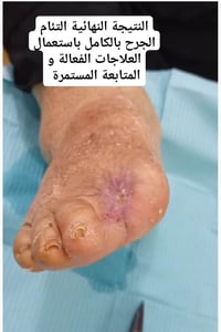 بتر اصبعين • قدم السكري • الديوانية