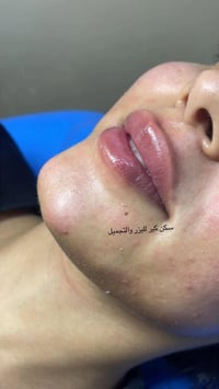 فيلر • حقن النضارة • سكن كير