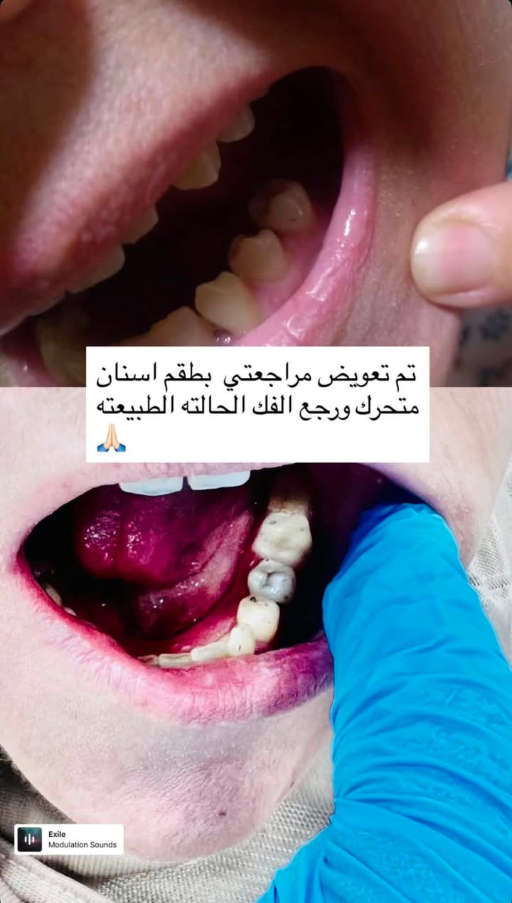 مجاناً….مجاناً…مجاناً
السلام عليكم تم فتح باب العيادات الهاي السنه و الحجز محدود نوفر الكم 
🦷تنضيف اسنان باحدث الادوات
🦷حشوات جذور وتجميليه بتقنيات متطوره
🦷قلع الاسنان التالفه
🦷تعويض طقم اسنان مفقوده
🦷تقويم اسنان حسب الحاله يحدد بعد الفحص
👶عيادات اطفال خاصه للعينايه و الوقايه من التسوس
العنوان كراده ساحه الاندلس عيادات جامعه الاسراء 
للتواصل ***********
