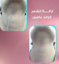 ليزر • أول جلسة • العبيدي