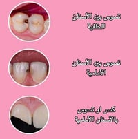 حشوات • قلع أسنان • خدمة مجانية