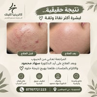 كاترينيا كلينك • علاج حب الشباب • د سهاد محمود