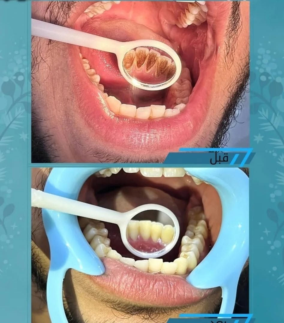 ✌🏻مميزون 😇💪🏻

 ✨ تنضيف الاسنان من جميع   التكلسات بجلسه واحده فقط 
           😇💪

من مركز 👈🏻 اليمامه التخصصي لطب الأسنان 💐

        بأيادي امهر الأطباء  
       👨🏼‍⚕️ 👨🏻‍⚕️👨‍⚕️👨🏽‍⚕️👨🏻‍⚕️

🦋 متواجدين وياكم طيله أيام الاسبوع من الساعه 4
 الئ ساعه 8  مۡسَـ(🍀)ـاء 

🌸 مجمع اليمامه الطبي التخصصي شارع ل 4000 الرئيسي

للأستفسار مراسله الصفحه 
او الاتصال على الرقم 
🌷 *********** 🌷
