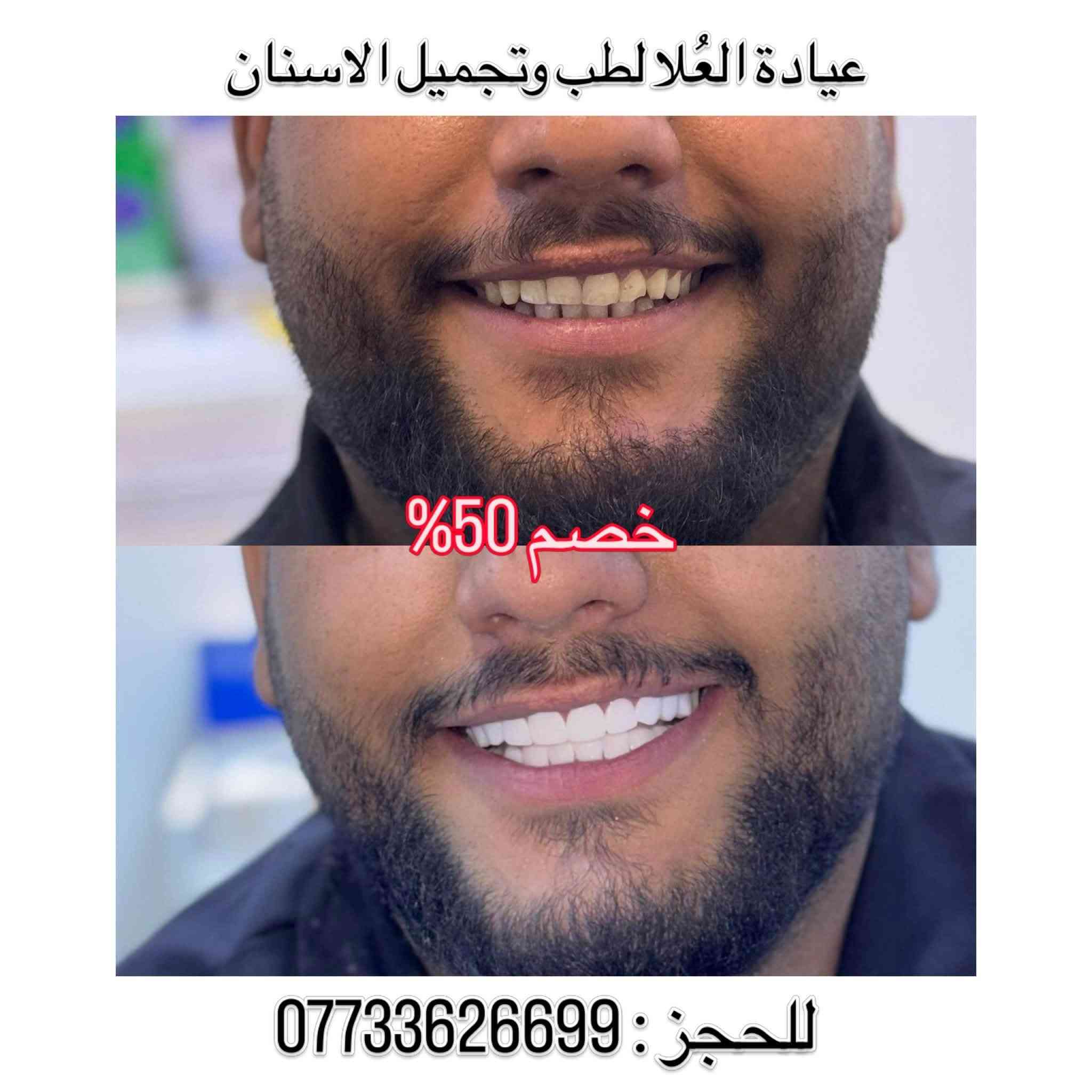 خصم ٥٠٪ • ابتسامة هوليوود • الشرطة الخامسة