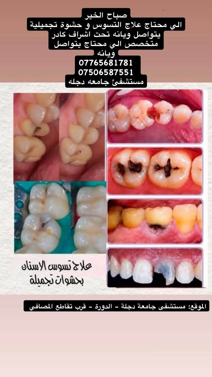 🦷 عندك مشكلة بأسنانك وتحتاج علاج؟

نستقبل حاليًا حالات علاج الأسنان مجانًا، وتشمل:

▫️ الحشوات الضوئية
▫️ قلع الأسنان وبقايا الجذور
▫️ تنظيف الأسنان وإزالة الجير والتصبغات
▫️ تعويض الأسنان المفقودة

👩🏻‍⚕️ يتم تقييم الحالة قبل العلاج، والعمل تحت إشراف أطباء اختصاص.

📍 بغداد، الدورة، شارع المصافي، عيادات كلية دجلة

📩 للحجز والاستفسار: ***********

***********

إذا تعرف شخص يحتاج علاج، شاركه المنشور 🤍🦷

نص مكتوب في الصور:
- DUCOD College Of Dentistry 2004 د. عبدالله فارس ستار كلية طب الأسنان - جامعة دجلة العلاج مجاني بإشراف أطباء اختصاص الخدمات المتوفرة تنظيف وتلميع الاسنان حشوات ضوئية طقم جزئي متحرك قلع الجذور المتبقية و الاسنان التواصل *********** *********** @dr_abdullah_fares @1_ym0 *********** كلية طب الاسنان - جامعة دجلة - الدورة - قرب تقاطع المصافي
- صباح الخير الي محتاج علاج التسوس و حشوة تجميلية يتواصل ويانه تحت اشراف كادر متخصص الي محتاج يتواصل ويانه *********** *********** مستشفي جامعه دجله علاج تسوس الاسنان بحشوات تجميلة الموقع: مستشفى جامعة دجلة - الدورة - قرب تقاطع المصافي
- صباح الخير الي محتاج تنظيف اسنان يتواصل ويانه تحت اشراف كادر متخصص الي محتاج يتواصل ويانه *********** *********** مستشفى جامعه دجله تنظيف وازالة التصبغات الموقع : مستشفى جامعة دجلة - الدورة -قرب تقاطع المصافي
- صباح الخير الي محتاج قلع اسنان اماميه يتواصل ويانه تحت اشراف كادر متخصص الي محتاج يتواصل ويانه *********** *********** مستشفى جامعه دجله الموقع :مستشفى جامعة دجلة - قرب تقاطع المصافي
- اهلا من الاسبوع الجاي راح نبدي نشتغل بعياداتنا تحت اشراف اطباء وكادر طبي متخصص
- لهذه الحالات الي راح اذكرها الي سالوني راسلوني احجز لكم موعد
- قلع الاسنان والجذور المتبقية:
- تعويض الاسنان المفقودة بطقم متحرك:
- الحشوات الضوئية وتكون بلون السن الاصلي:
- Before
- After
- تنظيف الاسنان وازلة البقع والتكلسات: