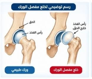 خلع الورك الولادي • سونار أطفال • عيادة العامل