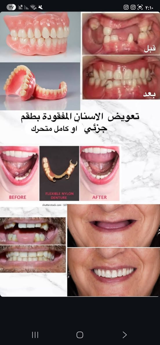 ( مجاني )

ديالى بعقوبة - جامعة اليرموك
الي عنده بقايا اسنان او اسنان تعبانة و تحتاج قلع يراسلني خاص او واتساب *********** نحجز موعد

العلاج مجاني و تحت إشراف اطباء اختصاص

الخدمات الى نقدمها :
_تنضيف اسنان وإزالة التصبغات و التكلسات
_حشوات ضوئية تجميلية وعلاجية
_تعویض اسنان مفقودة اسنان مفردة او كاملة 
_قلع اسنان او بقايا الجذور

نص مكتوب في الصور:
- قبل بعد تعويض الاسنان المفقودة بطقم جزئي او كامل متحرك BEFORE FLEXIBLE NYLON DENTURE AFTER
- تسوسات بين الاسنان الخلفيه او الاماميه