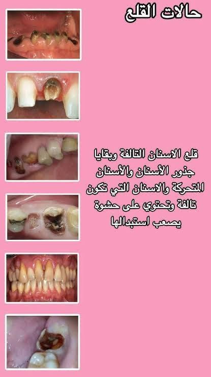 قلع أسنان • علاج مجاني • كلية الرافدين