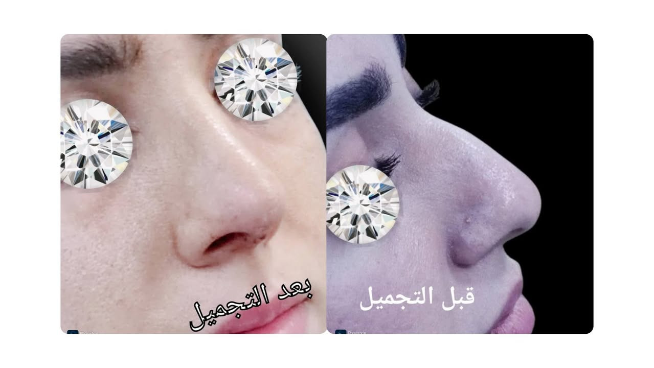 Natural Rhinoplasty
Alyasiery clinic for Rhinoplasty
***********
