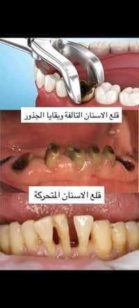 قلع أسنان مجاني • مستشفى الزهراوي • جميع الأعمار