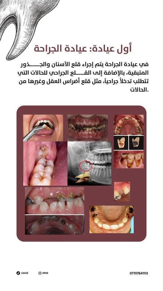 لا توجد تفاصيل

نص مكتوب في الصور:
- وراح تكون كل العيادات مجانية بالكامل وتحت اشراف مختصين تعالوا وياي اكلكم شنو راح نسوي LKAIZ OPGE ***********
- تتكون من عدة عيادات عيادة الحشوات عيادة الجراحة عيادة أمراض اللثة والتنظيف عيادة البروس او عيادة التعويضات السنية او التركيبات عيادة التقويم للاطفال عيادة الأطفال عيادة الأطفال الوقائية LKA1Z OP6E ***********
- أول عيادة: عيادة الجراحة في عيادة الجراحة يتم إجراء قلع الأسنان والجذور المتبقية، بالإضافة إلى القلع الجراحي للحالات التي تتطلب تدخلاً جراحياً، مثل قلع أضراس العقل وغيرها من الحالات. ***********
- ثاني عيادة: عيادة الحشوات
- في عيادة الحشوات يتم إجراء الحشوات التجميلية للأسنان المتسوسة أو المكسورة، وكل حالة تحتاج إلى حشوة. كما يتم إجراء حشوات الجذر للأسنان الأمامية فقط.
- LKA1Z
- OP6E
- ***********
- ثالث عيادة: عيادة البروس او عيادة التعويضات السنية او التركيبات في العيادة يتم العمل على الأطقم المتحركة لتعويض الأسنان المفقودة، سواء كان طقماً جزئيًا أو طقمًا كاملا. LKAIZ OP6E ***********