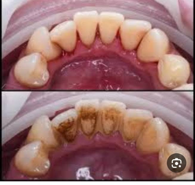 السلام عليكم 
إذا كنت تعاني من مشاكل الأسنان 
علاجك يمي 
اوفر لك 
حشوات ضوئية تجميلية 
تنظيف الأسنان وإزالة التكلسات والتصبغات 
قلع الاسنان التالفة والمتحركة والجذور المتبقية 
عمل طقم جزئي متحرك 

كل هذا والعلاج مجــاني بالكامــل  

المكان 
شـــارع فلـسطـيـن
 جــامعة المصـطفى 
للأستفــسار واتس أب ***********

نص مكتوب في الصور:
- قبل
- بعد