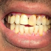 تنظيف أسنان • طالب طب اسنان • السيديه جامعة السلام