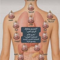 حجامة • مساج • علاج عرق النسا