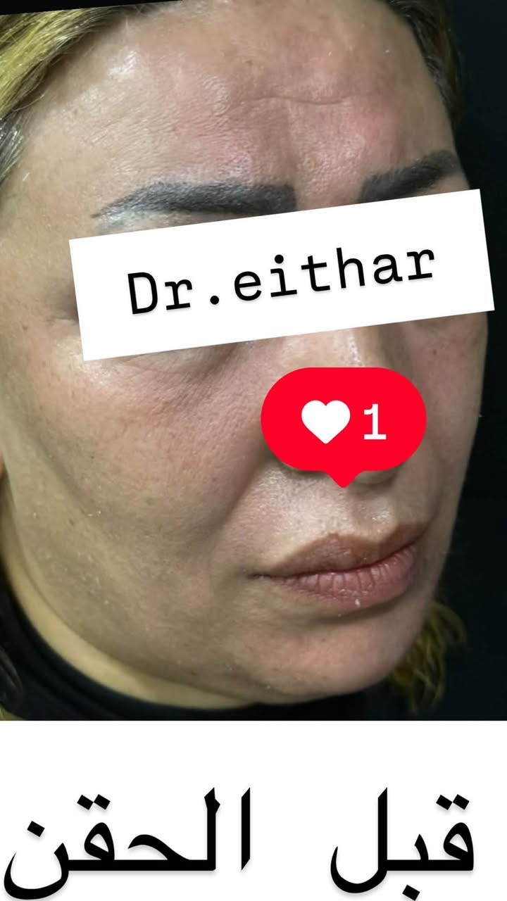 شد الوجه بالفلر والمحفزات  (لفتنك وجنات  واصداغ وتدوير الفك والذقن ونظاره وشفة فقط تعديل لان عدهه اختلاف بين الجهتين وبوتوكس  بعد اسبوعين من الحقن ) 🔥🔥🔥

اتمددت عروووض للكادر التدريسي والخريجات والموظفات والعروسات لنهايه الاسبوع ليوم الاربعاء اخر يوم  ثبتتهه الكم بالستوري بالهايلايت وببوست اعلى الصفحة ✨✨

د.ايثار سامي عبد الامير
واسط الكوت الهوره مجمع القبطان طابق اول 

الحجز***********

نص مكتوب في الصور:
- Dr.eithar 1 شد الوجه بالفلر والمحفزات(اصداغ ووجنات وتدوير الفك والذقن) وبوتوكس وشرفة فقط تعديل لان عده جهه بيه تليف نتيجة ضربة قديمه وعاليه
- Dr.eithar
- 1
- هنا النتيجة بعد اسبوعين بس
- شوفو التجاعيد بالكصه شون
- راحت وحول العين وانفتحت العين
- والحاجب انرفع
- Dr.eithar 1 لفتنك اصداغ وجنات وتدوير الفك والذقن بالفلر والمحفزات وبوتوكس وشفة فقط تعديل
- قبل الحقن نزول بالووجنات ومنطقة الفك صغيره وبيهاه نزول وترهل بحيث ماكو فصل بينه وبين اللغلوغ
- قبل الحقن