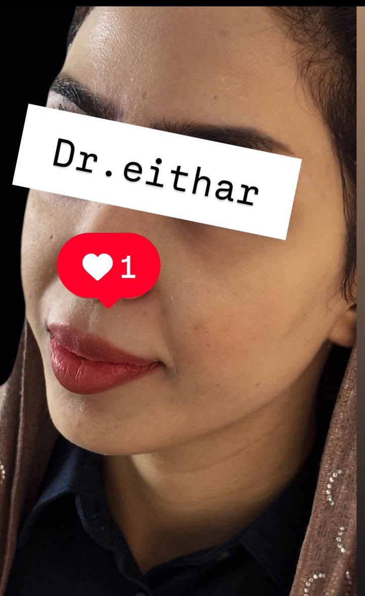 كونتور الوجه وشد بالفلر  (لفتنك وجنات  واصداغ وتدوير الفك والذقن ونظاره) 🔥🔥🔥

اتمددت عروووض للكادر التدريسي والخريجات والموظفات والعروسات لنهايه الاسبوع ليوم الاربعاء اخر يوم  ثبتتهه الكم بالستوري بالهايلايت وببوست اعلى الصفحة ✨✨

د.ايثار سامي عبد الامير
واسط الكوت الهوره مجمع القبطان طابق اول 

الحجز***********

نص مكتوب في الصور:
- Dr.eithar 1
- Dr.eithar
- 1