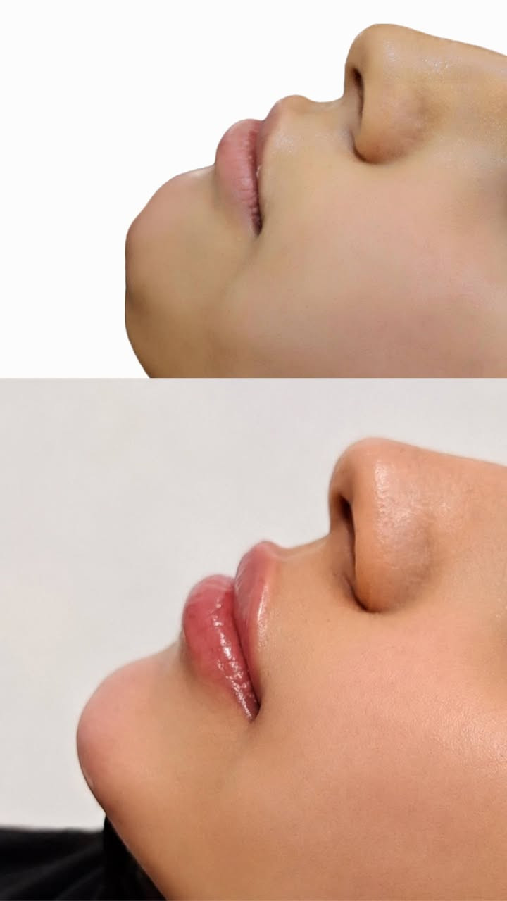 قسم التجميل 💉
السلام عليكم
على بركه اللّٰه
نعلن عن افتتاح قسم التجميل بعياداتنه الكائنه في( حي النداء شارع ٦٠)
العرض الاول للبوتوكس فقط ب85الف بدل 125
لأول5 مراجعين فقط يحصلون على جلسة البوتوكس شد الجبهة ورفع وسحبة الحاجب والتجاعيد حول العين
بوتوكس ابتسامه لثويه فقط ٥٠
بوتوكس تصغير فتحات الانف فقط ٥٠
بوتوكس صرير الاسنان ٥٠ الف فقط
بوتوكس التعرق ١٠٠ فقط
عرض الفلر لل1cc فقط 80الف بدل 100 الف الفحص والاستشاره
مجاناً
التغيير الشامل  للرجال والنساء لكل الوجه وجنات ذقن اصداغ  شفه 500 بدل 900 مع جلسه تنظيف اسنان وبلازما مجاناً
ابره الخلايا الجذعيه لتوقف تساقط الشعر وأنبات الشعر الجديد  75
يوجد أبر نضاره ومحفزات كولاجين وميزوات تفتيح وازاله
التصبغات
عليهن عروض حلوه لفتره محدوده
علما جميع المواد امنه
ومفحوصه ومسجله بوزاره الصحه
للأستفسار والحجز على الارقام الاتيه
***********
***********

