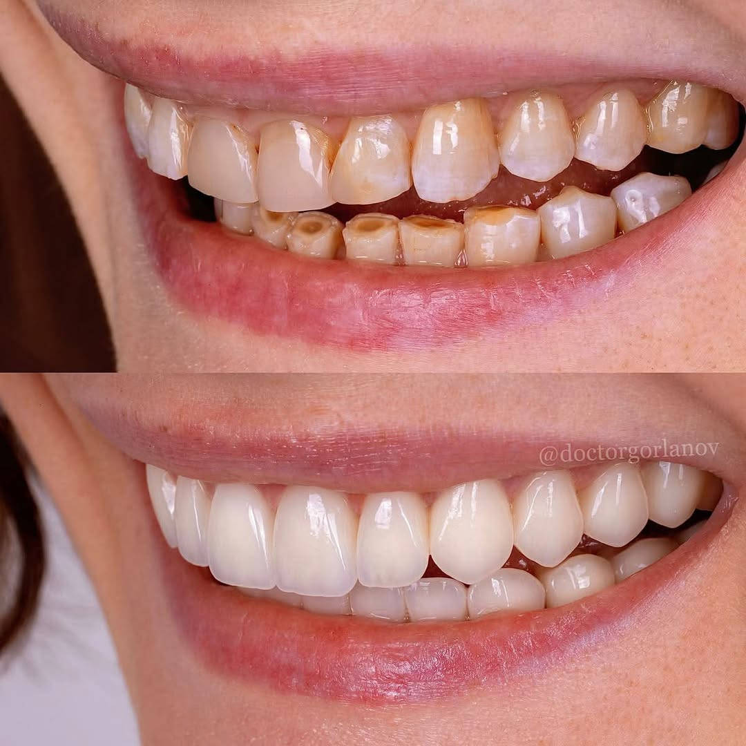 حشوات بيضاء • طقم اسنان متحرك • عيادات جامعة النور