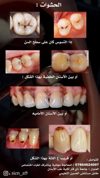 معالجة مجانية • حشوة ضوئية • قلع أسنان