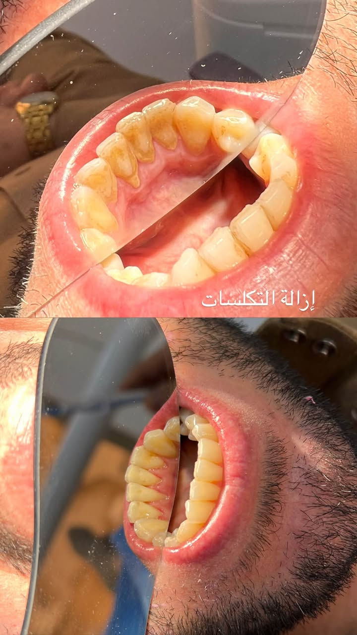 عيادات جامعة المعارف • طقم اسنان متحرك • تنظيف اسنان