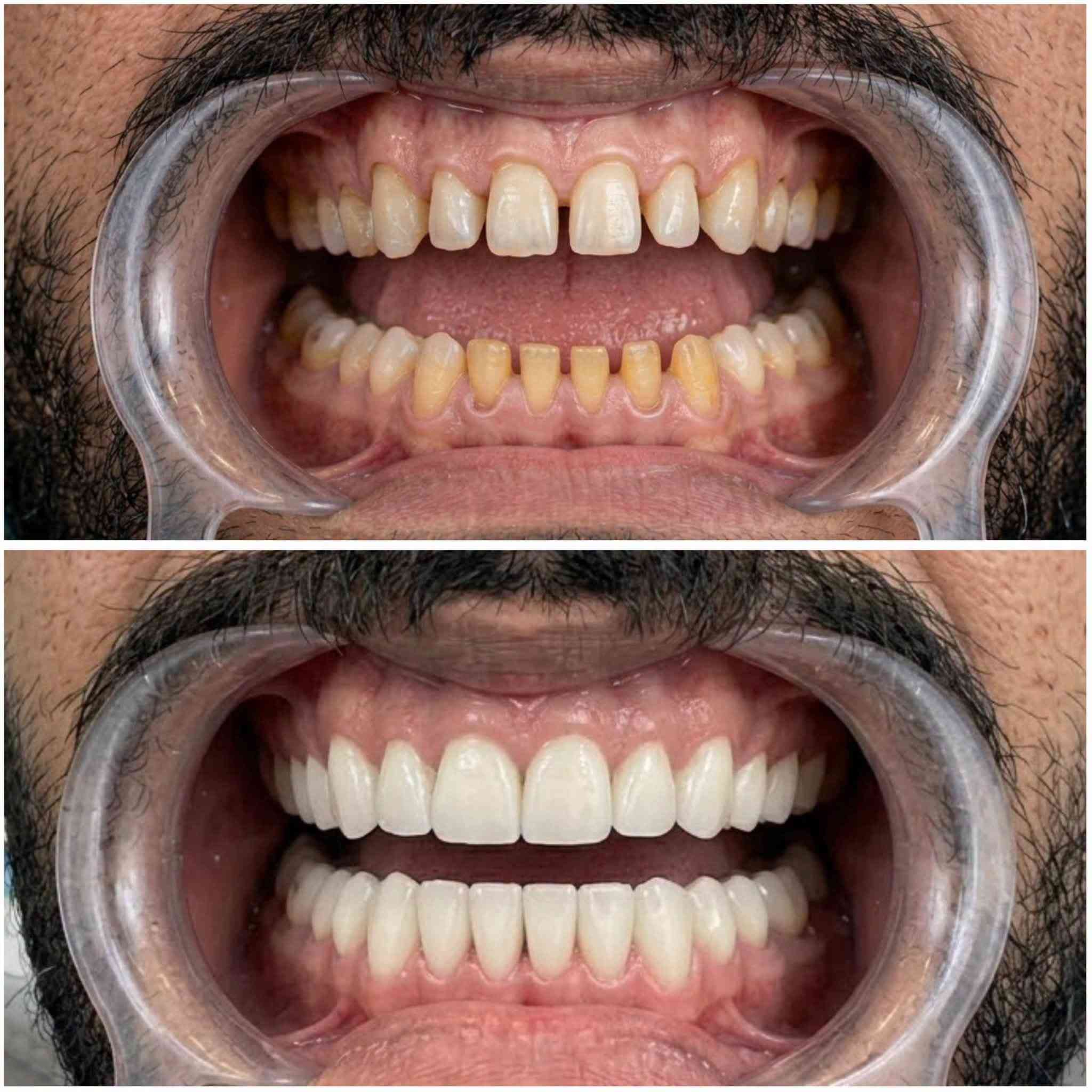 😁✨ ابتسامتك يمنا غير!

خلّي ابتسامتك تحچي عنك 🤍
عناية متخصصة وابتسامة تليق بملامحك مع كادر قسم الأسنان 🦷✨

📍 الموقع: واسط – العزيزية – شارع الخليج – جانب البوابة
📞 للحجز والاستفسار: ***********

🏥 مستشفى روح الحياة الأهلي
🦷 قسم الأسنان
